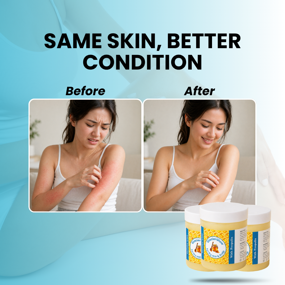 GlacierGlow - Steroid Free Balm For Eczema & Psoriasis